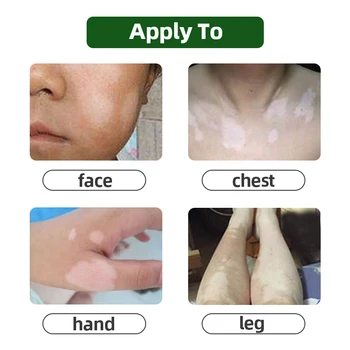 Leukoplakia Zdravljenje Bolezni Mazilo Vitiligom Repair Cream Belo Mesto Kitajske Medicinske Pigment Melanin Balzam Za Nego Kože